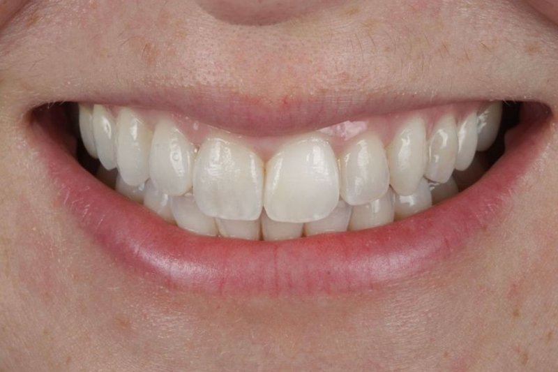 Teeth Whitening Case Study in Wilmslow, Cheshire