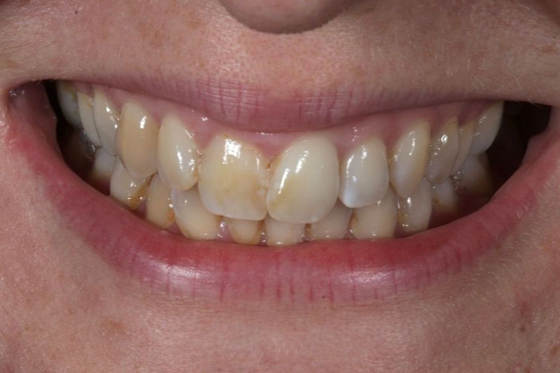 Teeth Whitening Case Study in Wilmslow, Cheshire