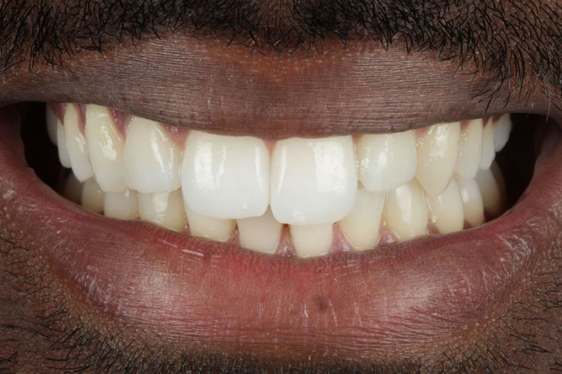 Teeth Whitening Case Study in Wilmslow, Cheshire