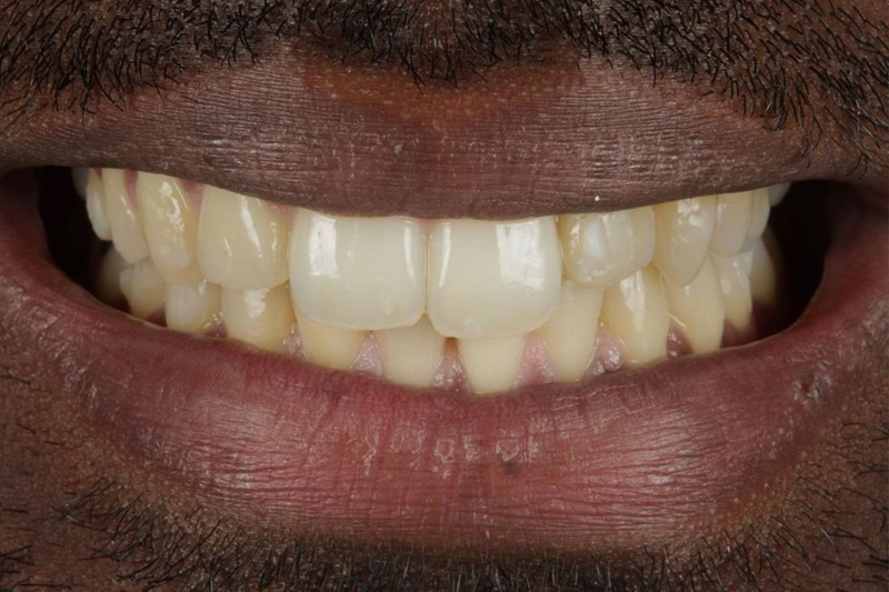 Teeth Whitening Case Study in Wilmslow, Cheshire