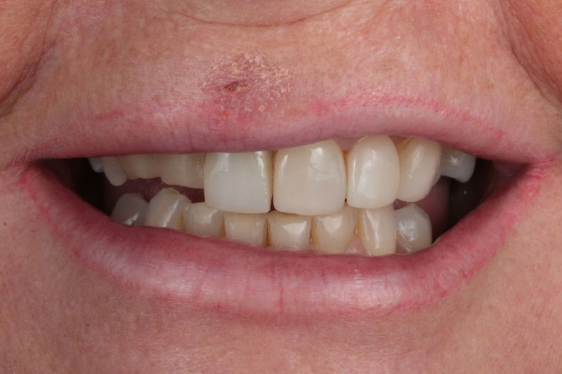 Porcelain Veneers Case Study in Wilmslow, Cheshire