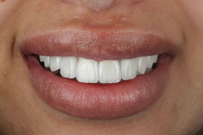 Layered Composite Veneers in Wilmslow, Cheshire