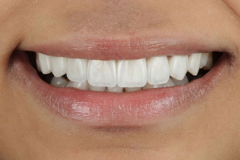 Layered Composite Veneers in Wilmslow, Cheshire