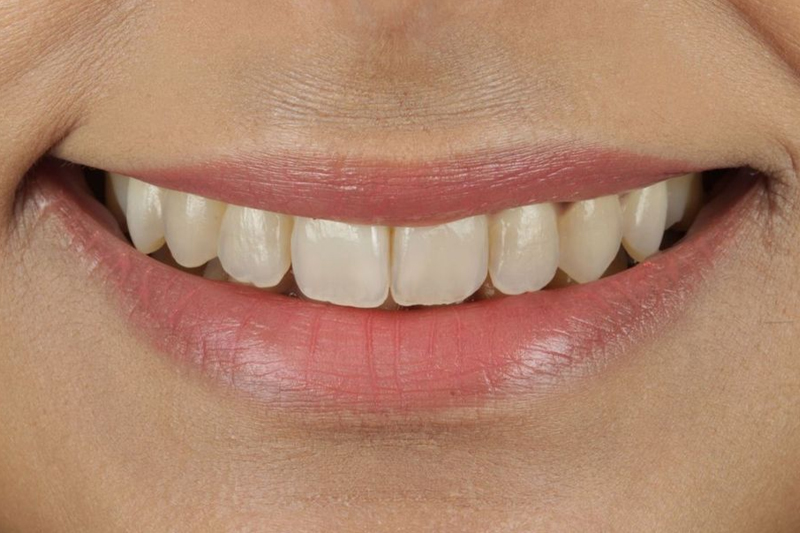 Layered Composite Veneers in Wilmslow, Cheshire