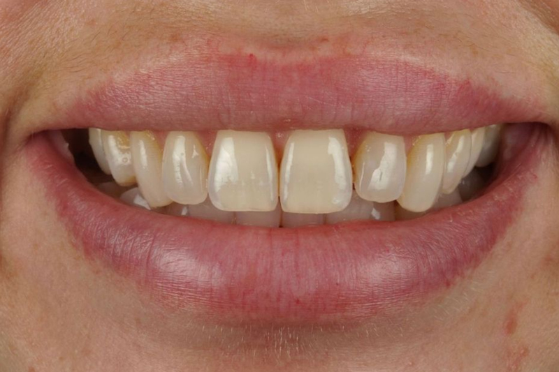 Layered Composite Veneers in Wilmslow, Cheshire