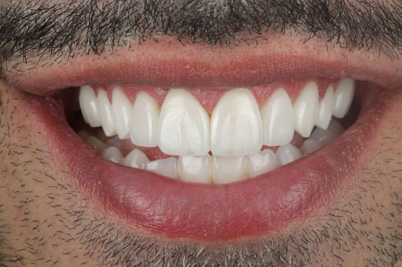 Layered Composite Veneers in Wilmslow, Cheshire
