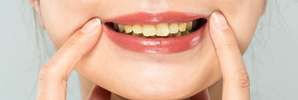How Can I Improve a Dull or Discoloured Smile?