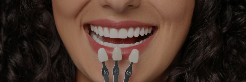 The Art of Layered Veneers: LUME's Signature Smile Transformation in Wilmslow