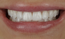 After 1 Clear Aligners