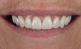 After 1 Dental Implants