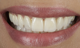 After 2 Clear Aligners