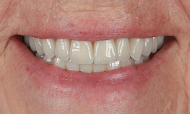 After 2 Dental Implants