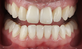 After 3 Clear Aligners