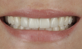 After 4 Clear Aligners