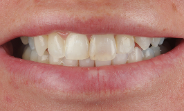 After 5 Clear Aligners