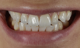 Before 1 Clear Aligners