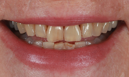 Before 1 Dental Implants