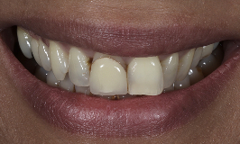 Before 2 Clear Aligners