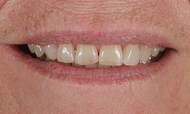 Before 2 Dental Implants