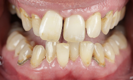 Before 3 Clear Aligners