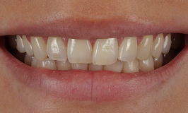 Before 4 Clear Aligners