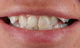 Before 5 Clear Aligners