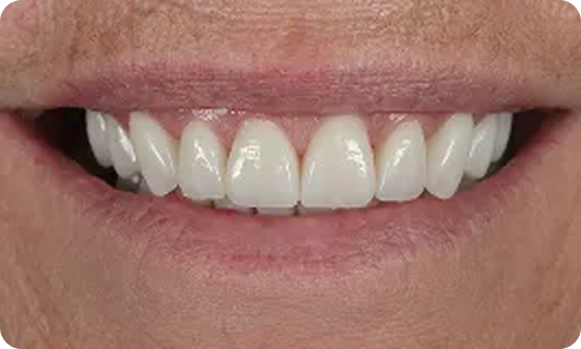 clear aligner-teeth