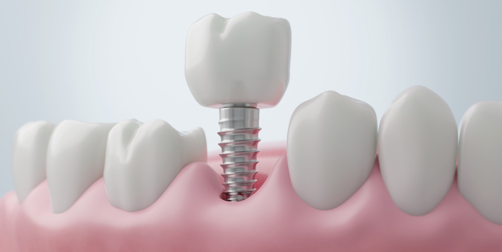 titanium implants going into gum